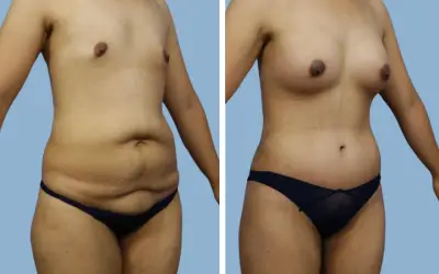 Before and After